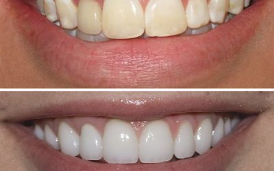 We Now Offer Zoom Same Day Whitening
